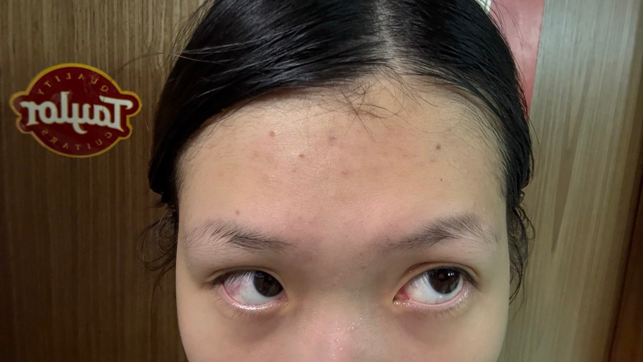 Me after image forehead